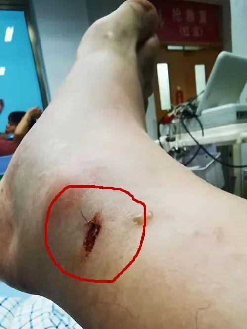 浙江男子被“超级毒蛇”咬了一口！一通神操作惊呆网友：这波自救太绝了