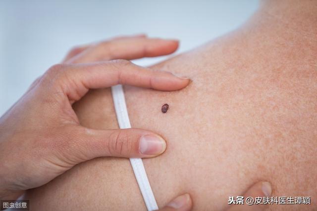 皮肤科医生和你简单聊聊：我的这个色素痣应该处理吗？