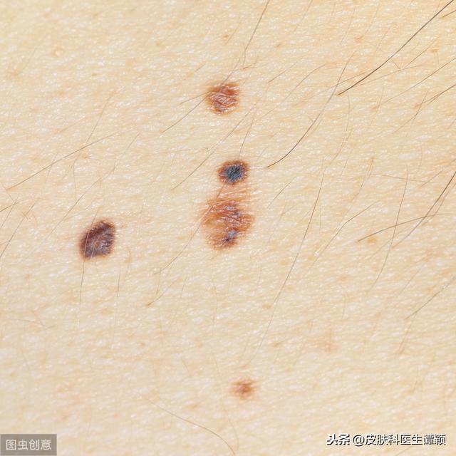 皮肤科医生和你简单聊聊：我的这个色素痣应该处理吗？