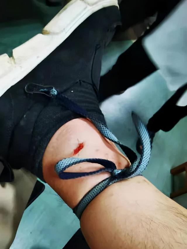 男子散步时被超级毒蛇咬了一口，自己一通神操作后保住了命！事后直呼“我@￥大！”