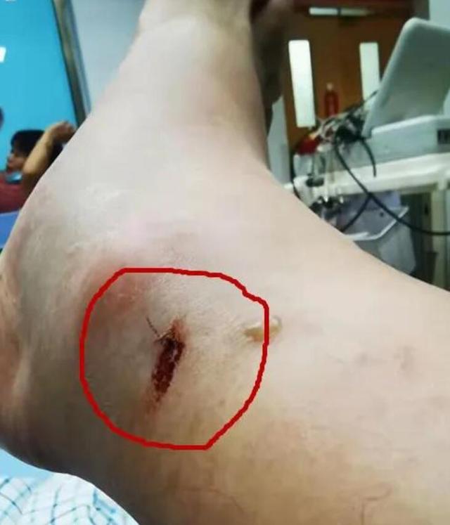 命大！浙江男子被五步蛇烙铁头咬伤，自救成功，它的毒性有多强？