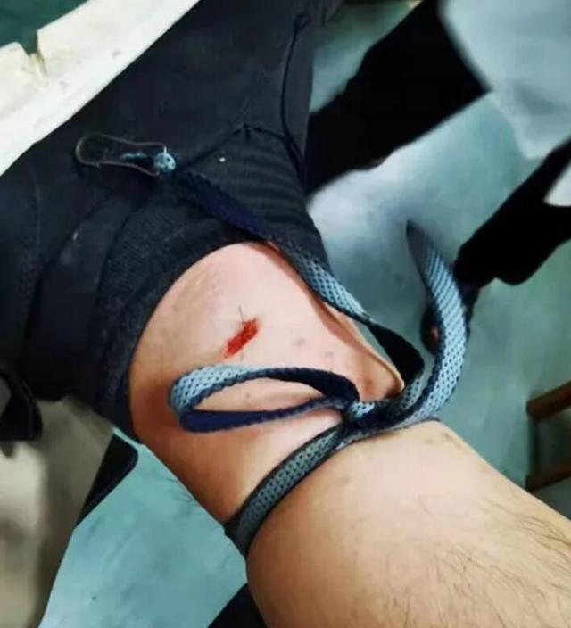命大！浙江男子被五步蛇烙铁头咬伤，自救成功，它的毒性有多强？
