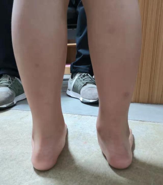 生辰脚是不是脚内翻，影响跑步吗？应该怎么矫正呢？
