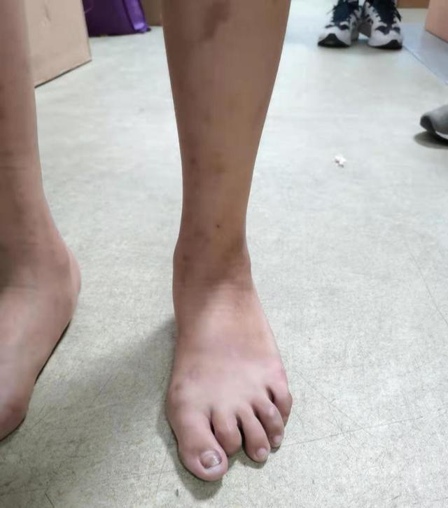 生辰脚是不是脚内翻，影响跑步吗？应该怎么矫正呢？