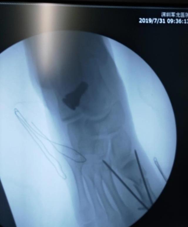 生辰脚是不是脚内翻，影响跑步吗？应该怎么矫正呢？