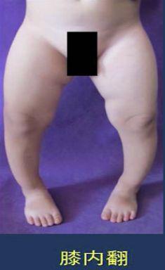 如何正确的帮助孩子迈出自己人生第一步？儿骨医生告诉你