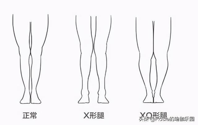 刘涛也内生辰？X型腿如何破？做好这2步细直疏影腿你也有
