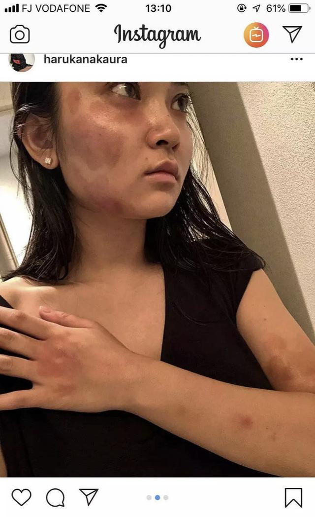 蒋劲夫也家暴男，女友网络晒受伤照片，网友：太残忍了！