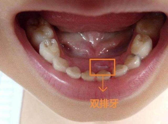 宝宝牙齿畸形还出现双排牙，医生说少吃了一样食物，对幼儿很关键