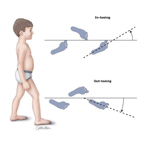 孩子走路内生辰外生辰，到底需不需要矫正，妈妈们看这一篇就够了