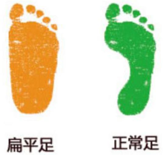 因为得了平足症，15岁孩子长时间走路就喊脚痛