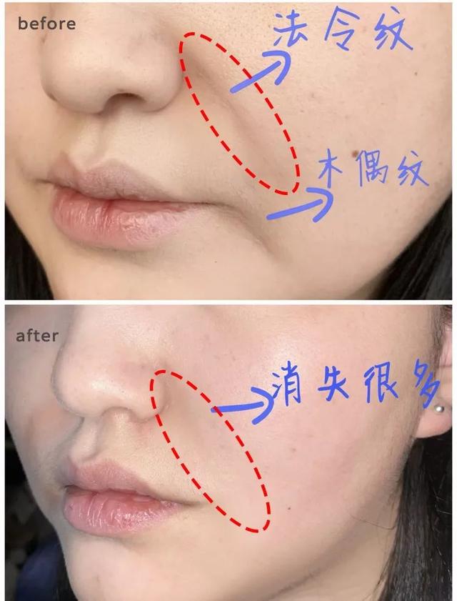 法令纹、眉间纹又凶又老！贴上它，睡走“三八”脸！胜过10次除皱针