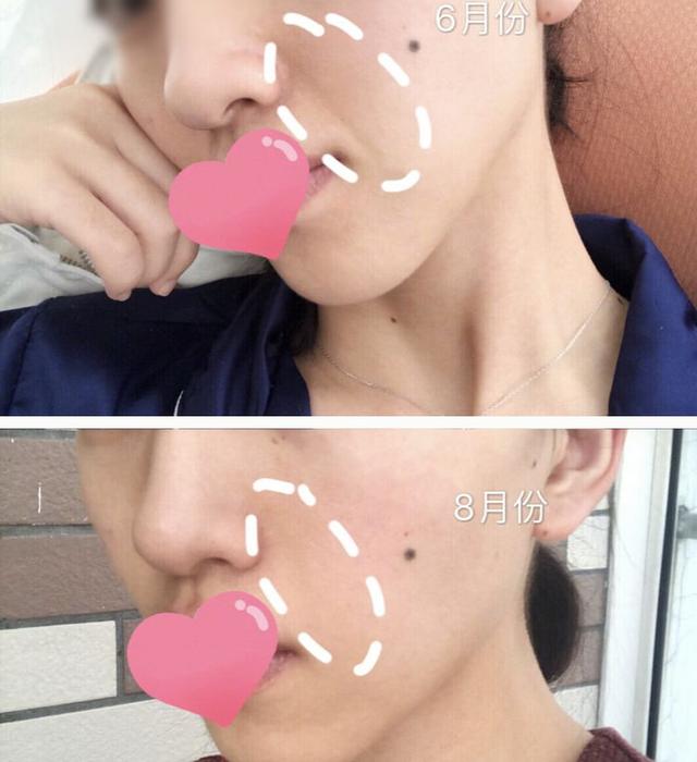 法令纹、眉间纹又凶又老！贴上它，睡走“三八”脸！胜过10次除皱针