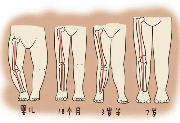 辟谣 I 网上说O型腿会遗传真的吗？医生：并不是