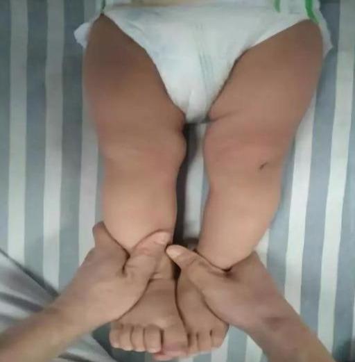 辟谣 I 网上说O型腿会遗传真的吗？医生：并不是