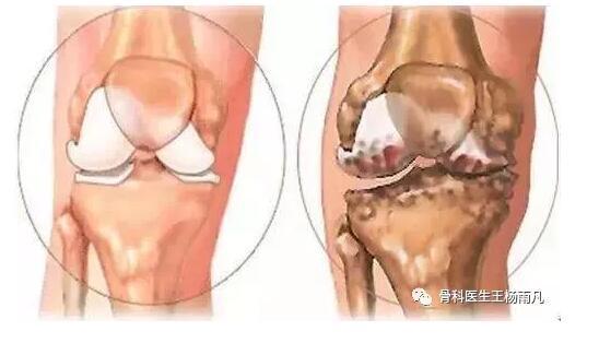 膝关节疼痛的16种最常见原因速查