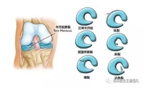 膝关节疼痛的16种最常见原因速查