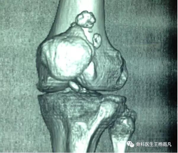 膝关节疼痛的16种最常见原因速查