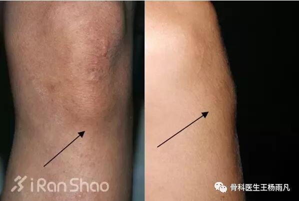 膝关节疼痛的16种最常见原因速查