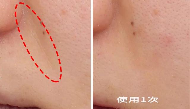 冻龄 | 法令纹、眉间纹又凶又老！贴上它，睡走“三八”脸