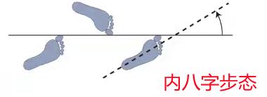 孩子走路“内生辰”需要纠正吗？