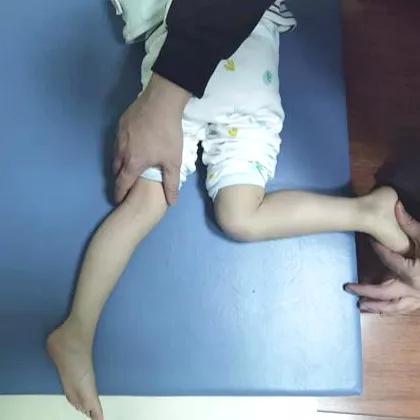 孩子走路“内生辰”需要纠正吗？