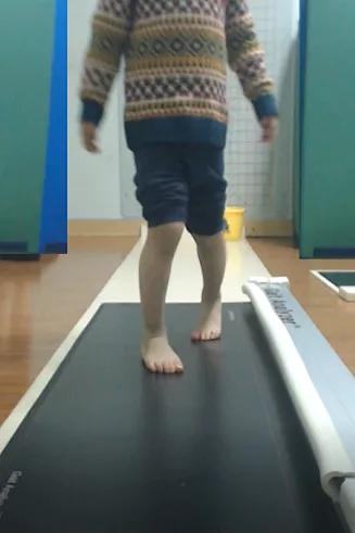 孩子走路“内生辰”需要纠正吗？