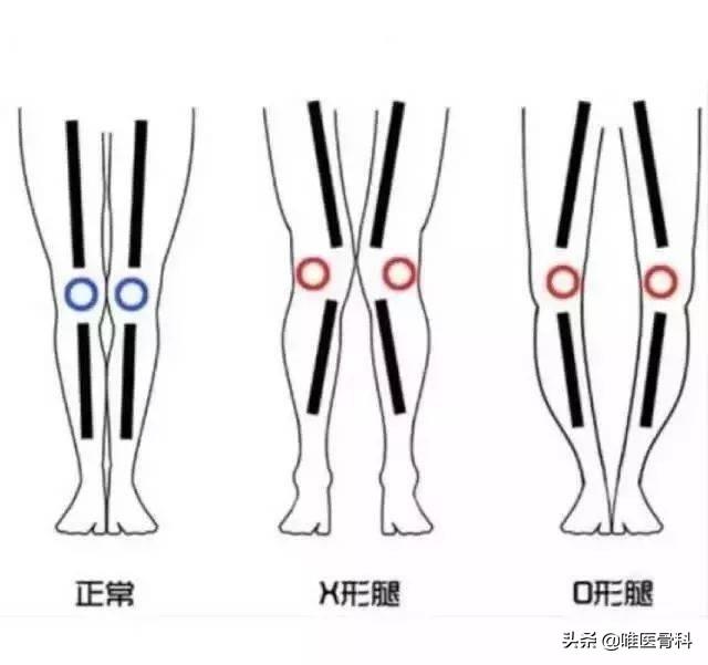O 型腿和 X 型腿是儿童发育的必经生理曲线？后悔没早点知道
