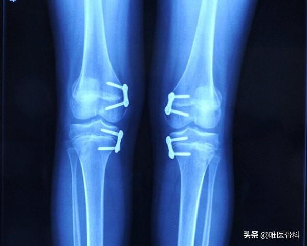 O 型腿和 X 型腿是儿童发育的必经生理曲线？后悔没早点知道