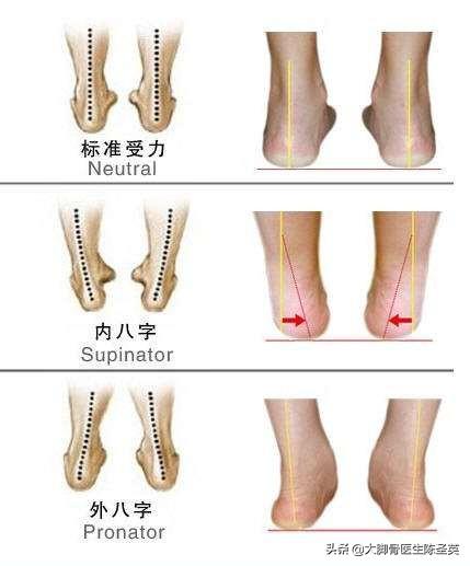 孩子走路内生辰如何纠正