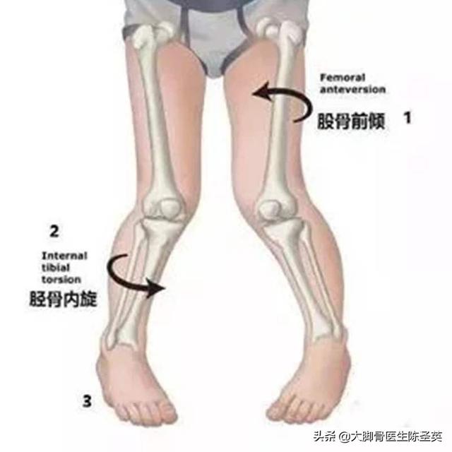 孩子走路内生辰如何纠正