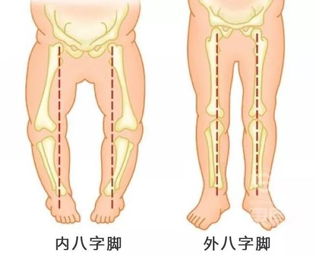 体态纠正：内、外生辰脚训练改善方法，建议收藏