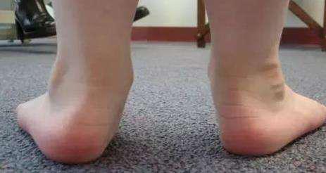 宝宝走路“内生辰”?出现这些情况要尽快找医生咨询