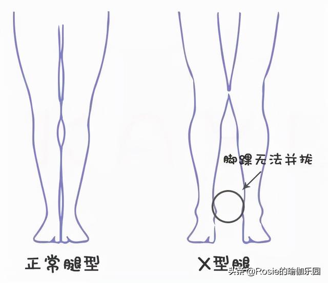 46岁佘诗曼马甲线长腿似少女，双腿内扣有鼓包如何破？5步带你练