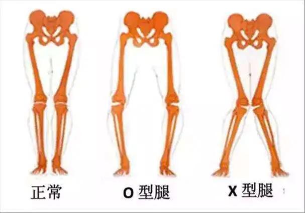 1到2岁的宝宝走路有点内八字正常吗